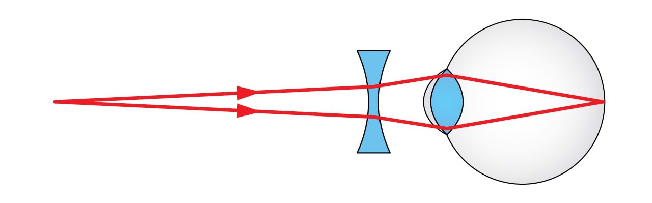 Lühinägelikkuse korrigeerimine